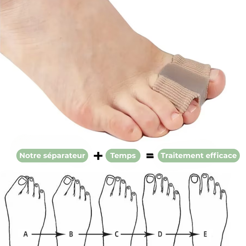 4x Séparateurs d'orteils Spécial Hallux Valgus