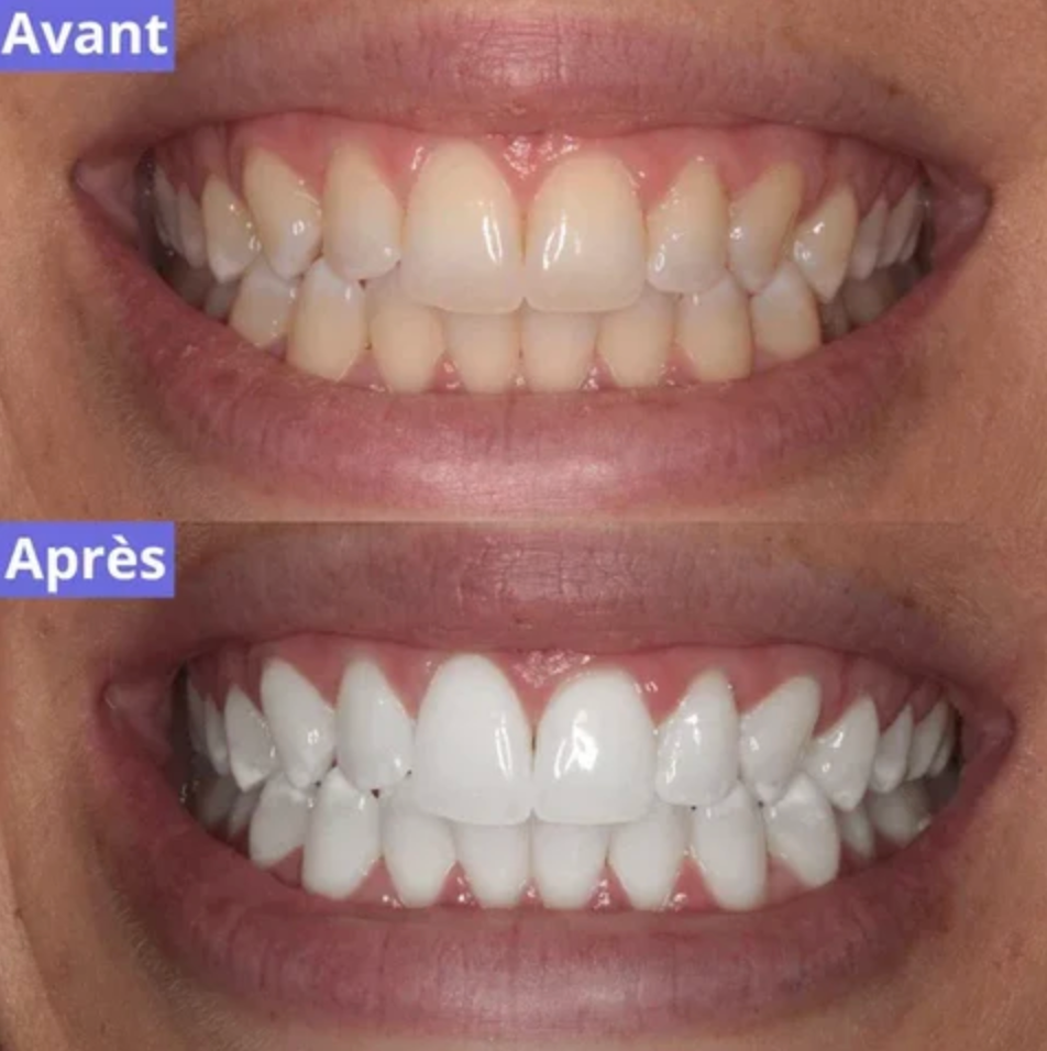 Stylo Magique Dents Blanches au Gel Violet - 2 ACHETÉS = 1 OFFERT