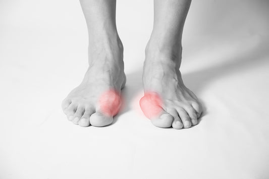 Hallux valgus qu'est ce que c'est et comment y remédier ?