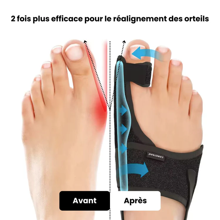 Attelle Hallux Valgus Réglable avec Barre Métallique