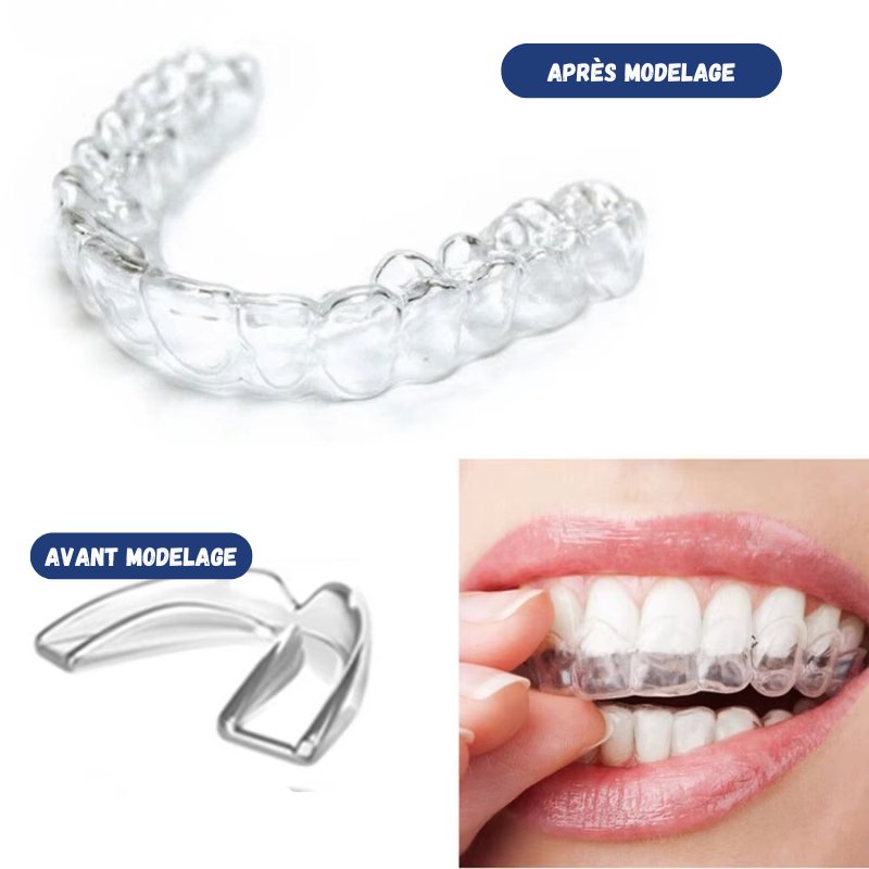 Lot de 4 Gouttières à Modeler Anti-Ronflement