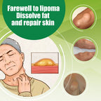 Crème Apaisante de Soin des Lipoemes et Nodosités