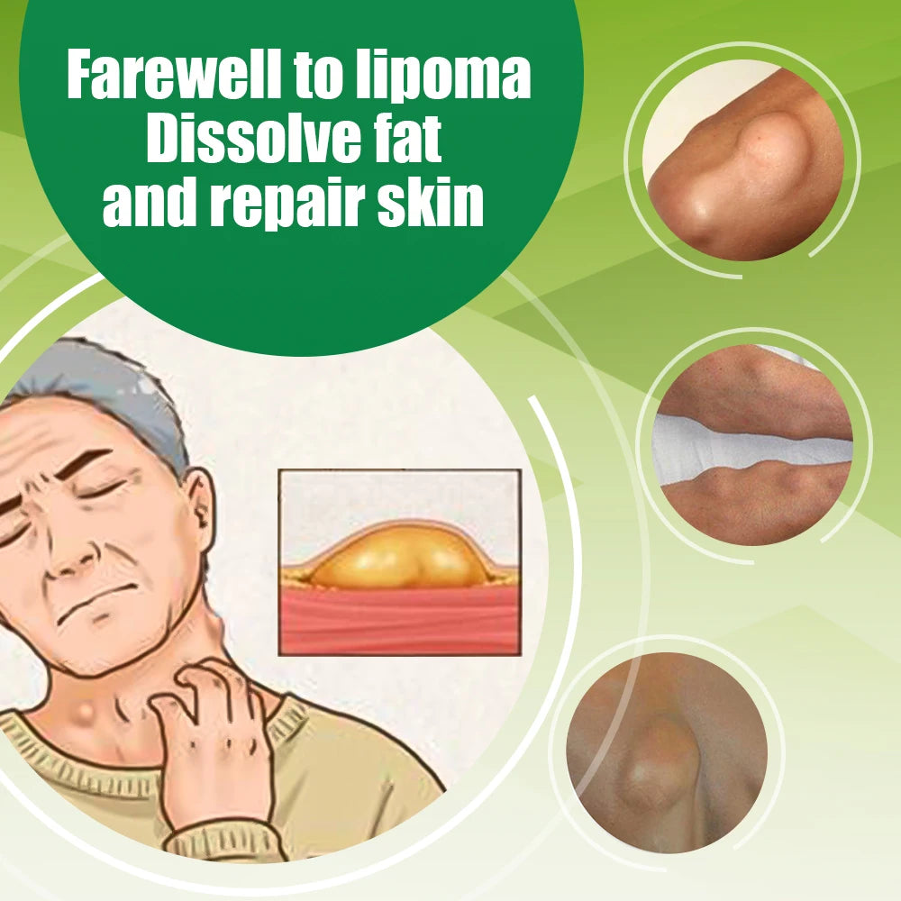 Crème Apaisante de Soin des Lipoemes et Nodosités