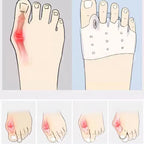 4x Coussinets en Silicone pour l'avant-pied - Alignement des orteils