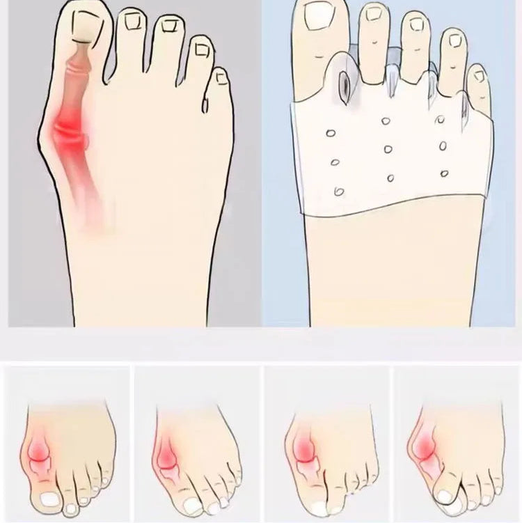 4x Coussinets en Silicone pour l'avant-pied - Alignement des orteils