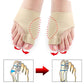 Correcteur orthopédique pour Hallux Valgus (Oignon)