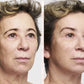 Face Lift - Adhésifs lifting invisible naturel