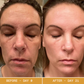 LUMILIFT - Appareil de soin visage luminothérapie