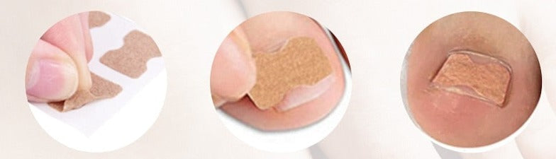 Patchs correcteurs d'ongles incarnés