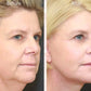 Face Lift - Adhésifs lifting invisible naturel